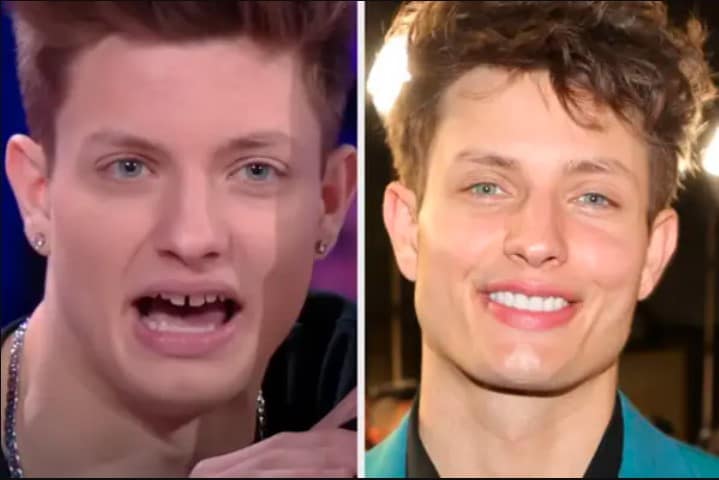 Matt Rife’s Smile Transformation