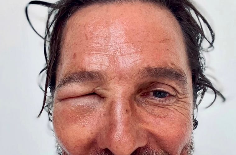 Matthew McConaughey Bee Sting Swollen Eye