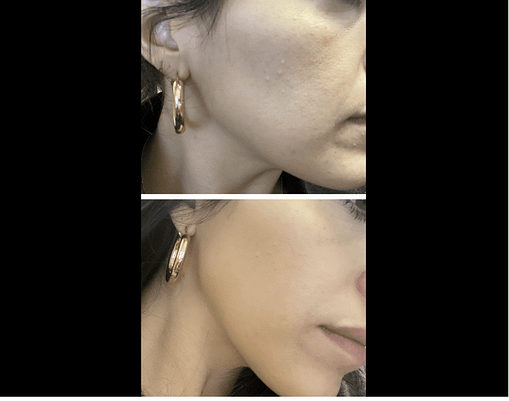 Paula's Choice Exfoliant before and after