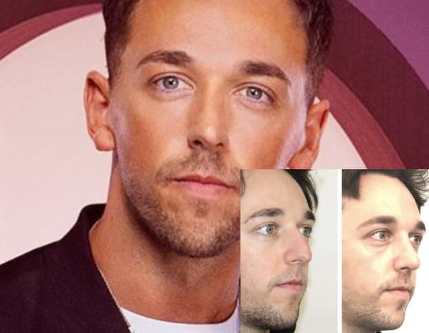 Sam Love Is Blind UK Nose Job Before And After