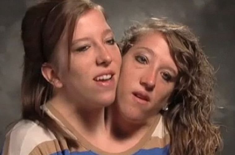 How Did Conjoined Twins Get Married
